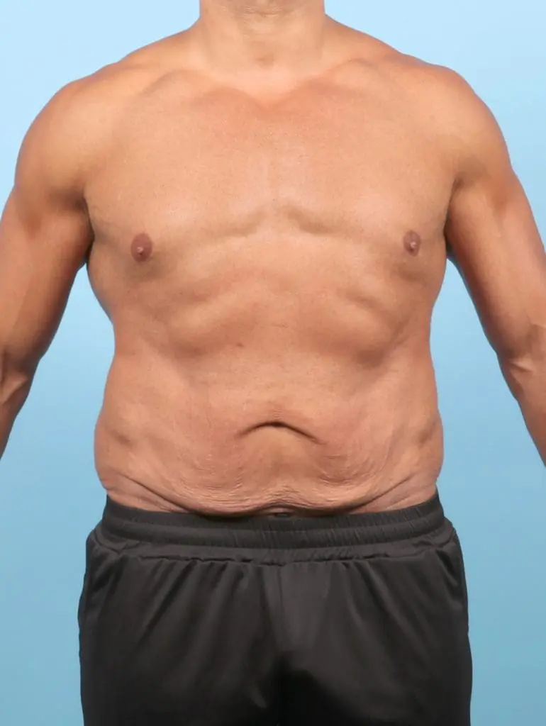 After Weight Loss - Case 58065 - Before