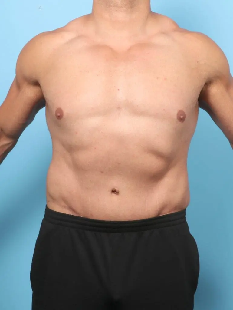 After Weight Loss - Case 58065 - After