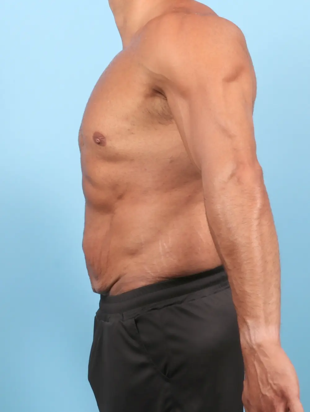 After Weight Loss Patient Photo - Case 58065 - before view-2