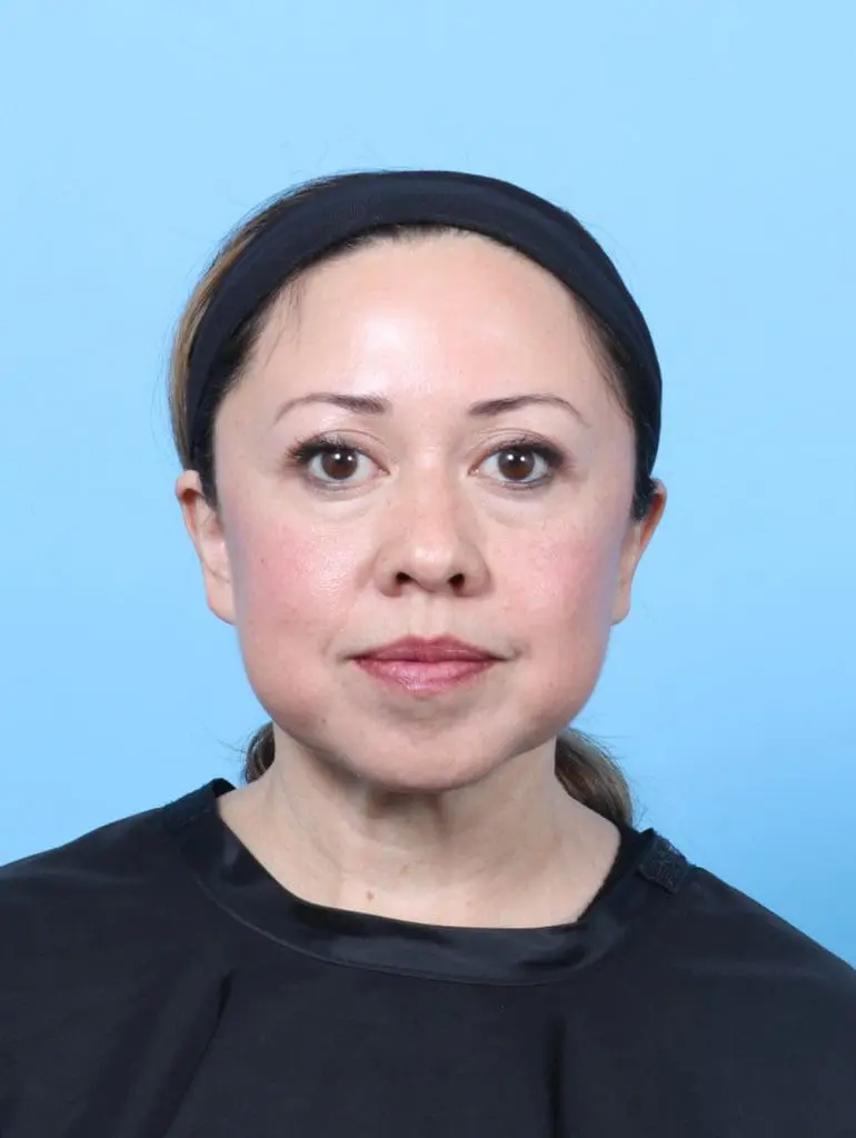 Eyelid Surgery - Case 58073 - After