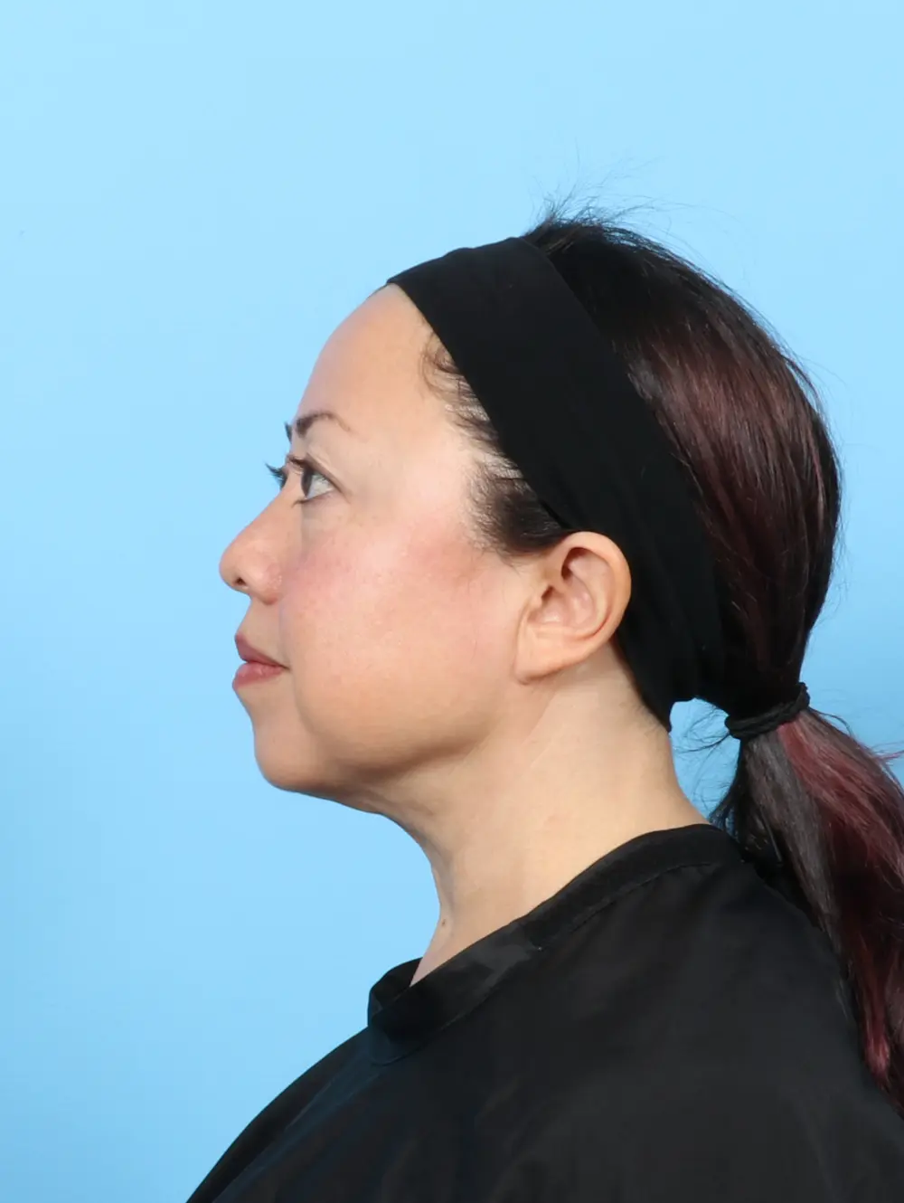 Eyelid Surgery Patient Photo - Case 58073 - before view-2