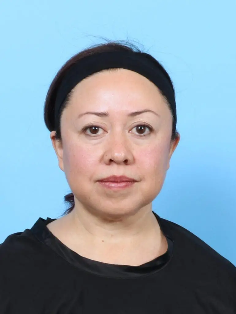 Eyelid Surgery - Case 58073 - Before