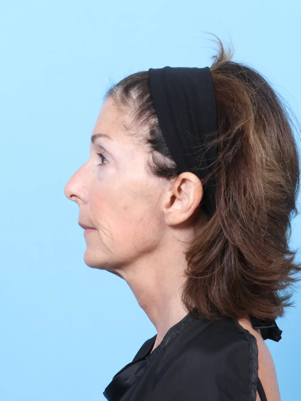 Eyelid Surgery Patient Photo - Case 58111 - before view-2