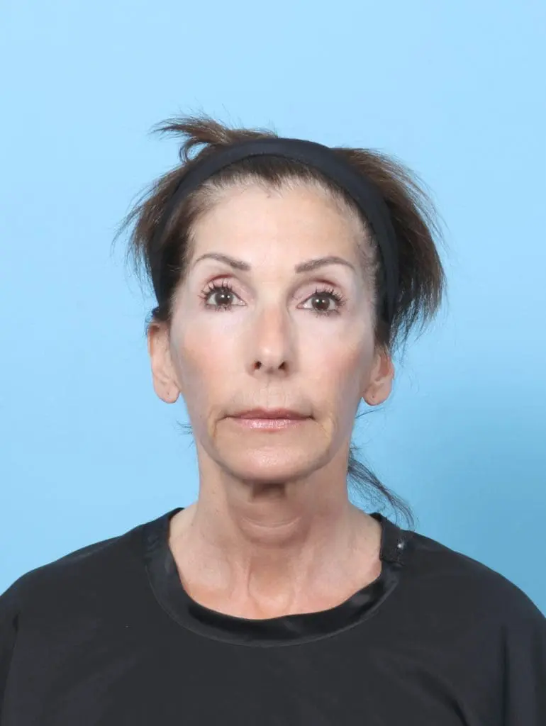 Eyelid Surgery - Case 58111 - After