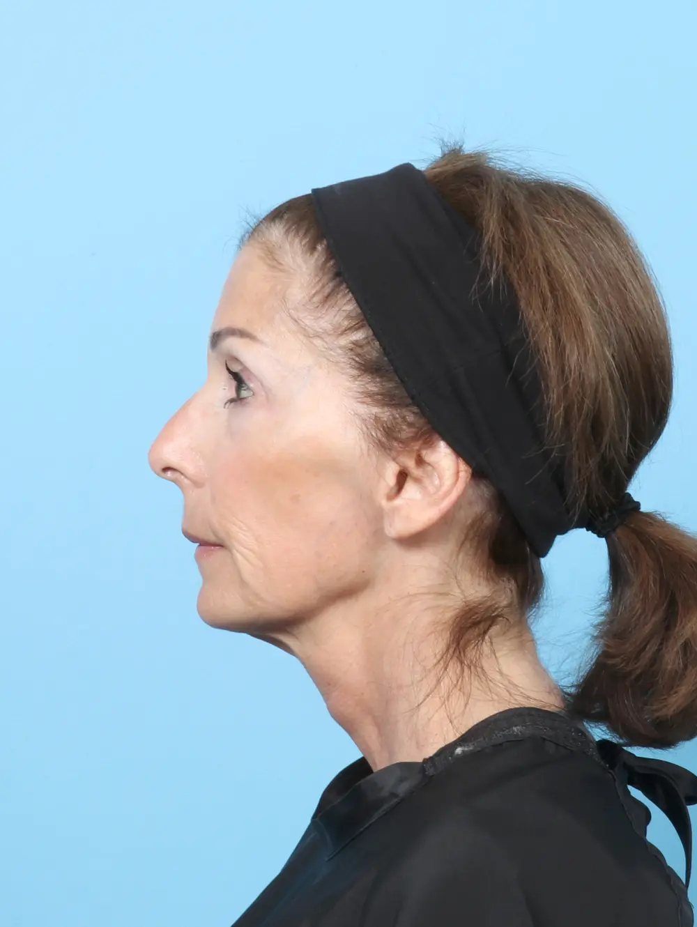 Eyelid Surgery Patient Photo - Case 58111 - after view-2