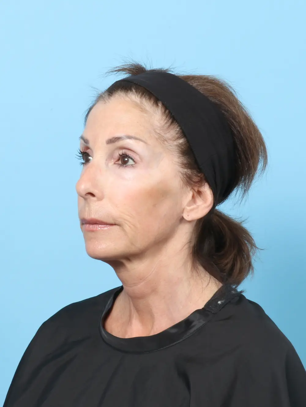 Eyelid Surgery Patient Photo - Case 58111 - after view-1