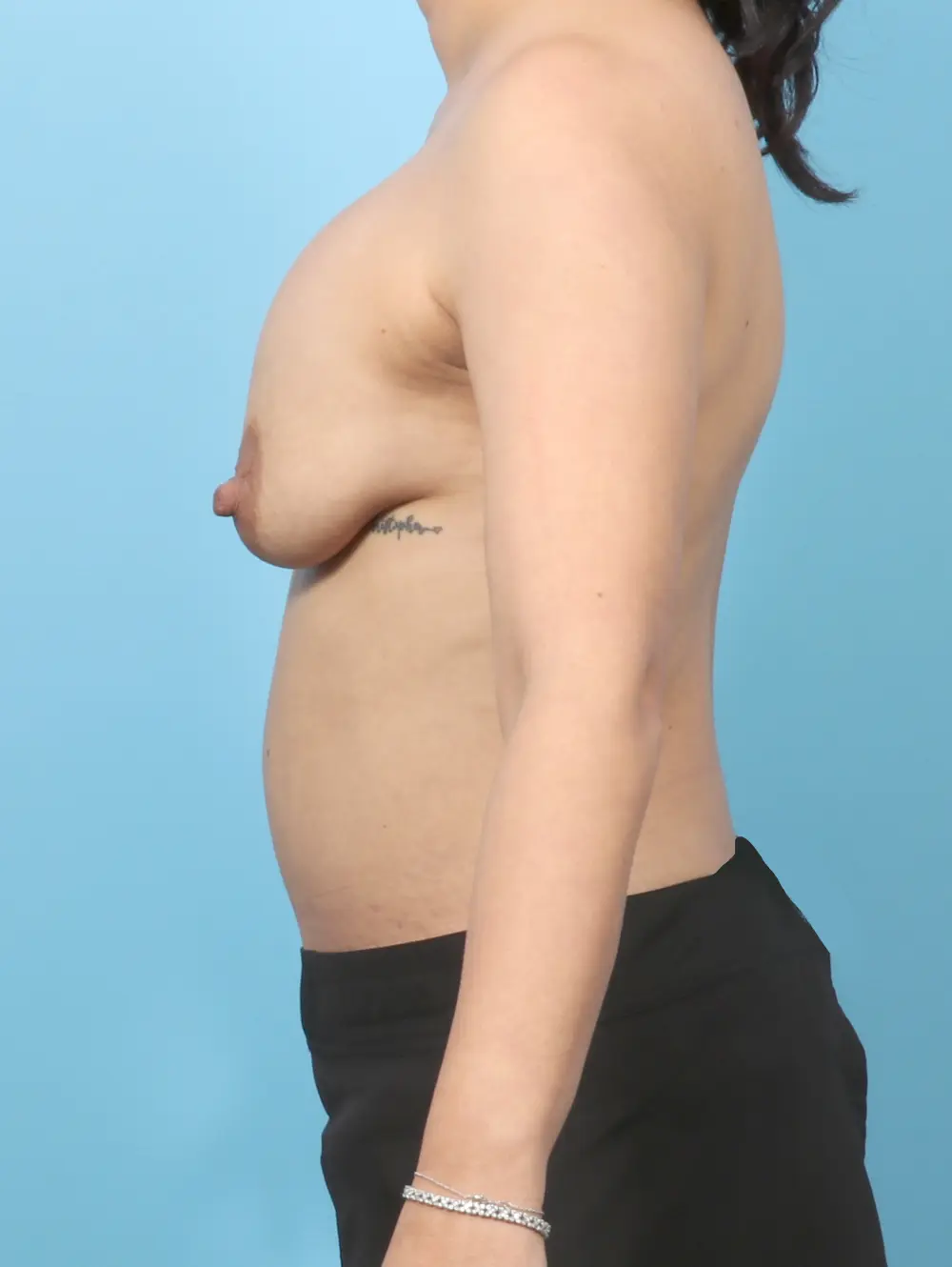 Breast Implant Removal Patient Photo - Case 58146 - before view-2