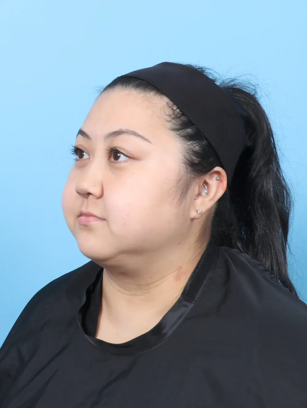 Liposuction Patient Photo - Case 58155 - after view-1