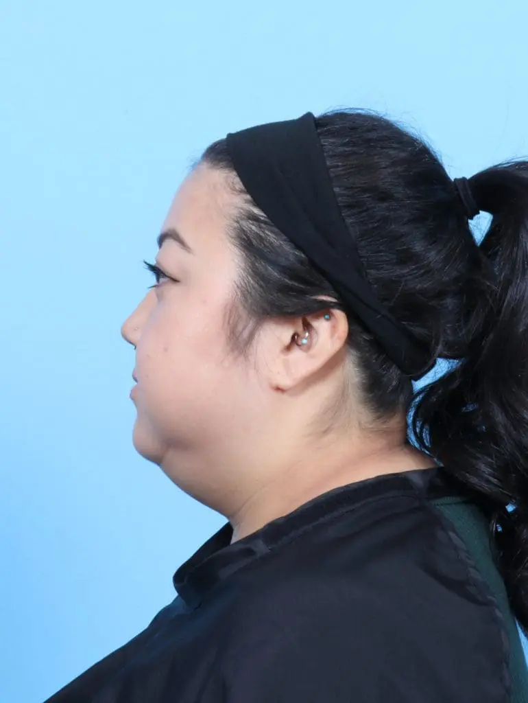 Liposuction - Case 58155 - Before