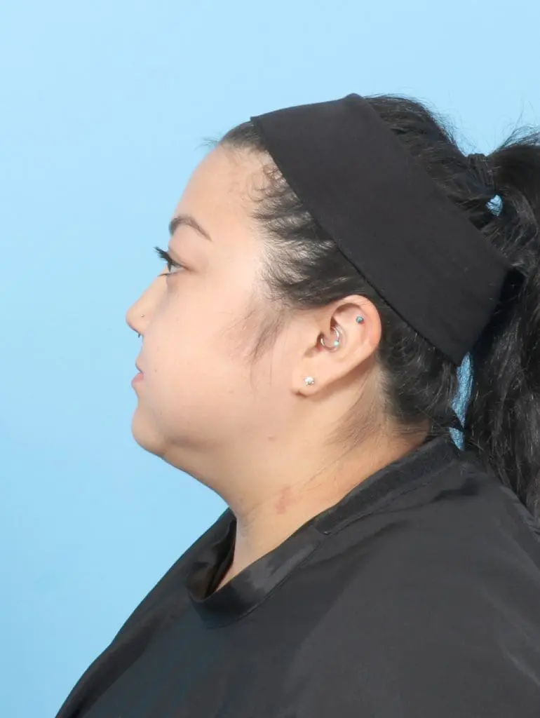 Liposuction - Case 58155 - After