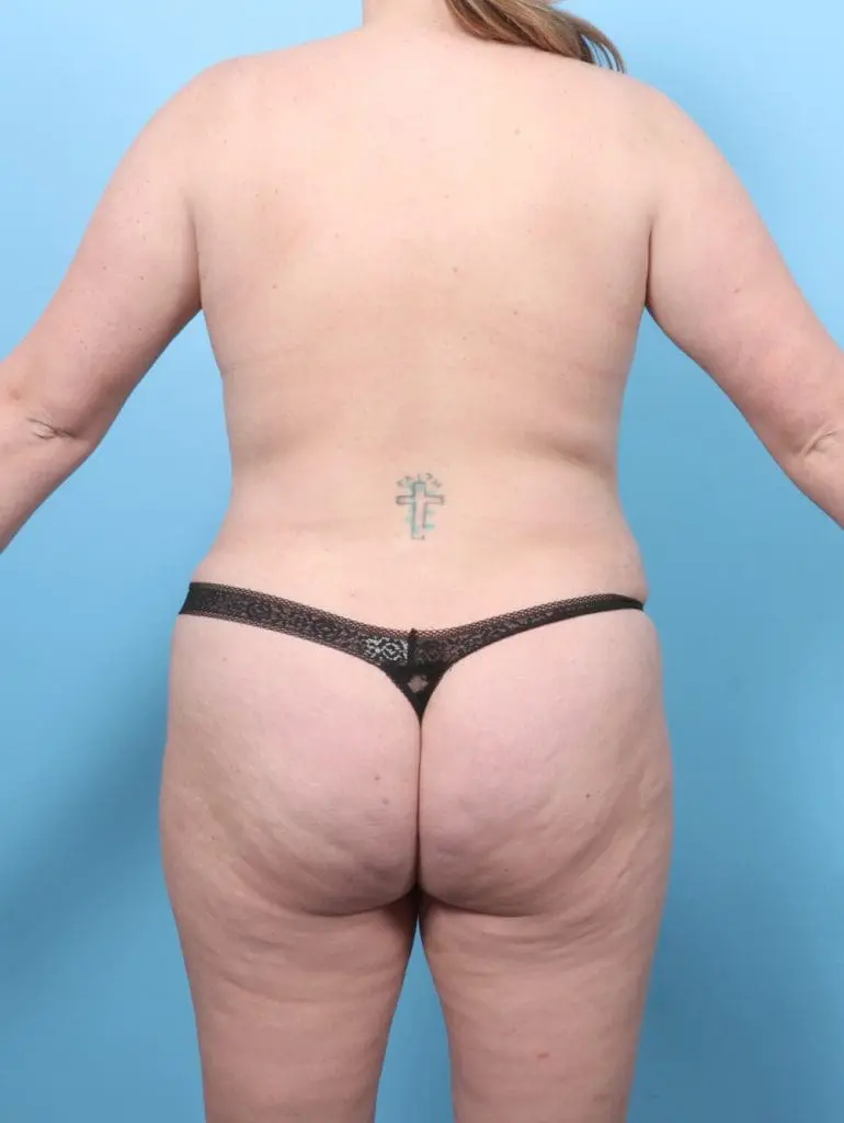 Liposuction - Case 58193 - After