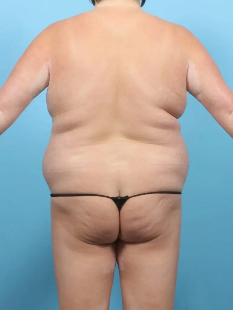 Liposuction - Case 58199 - Before