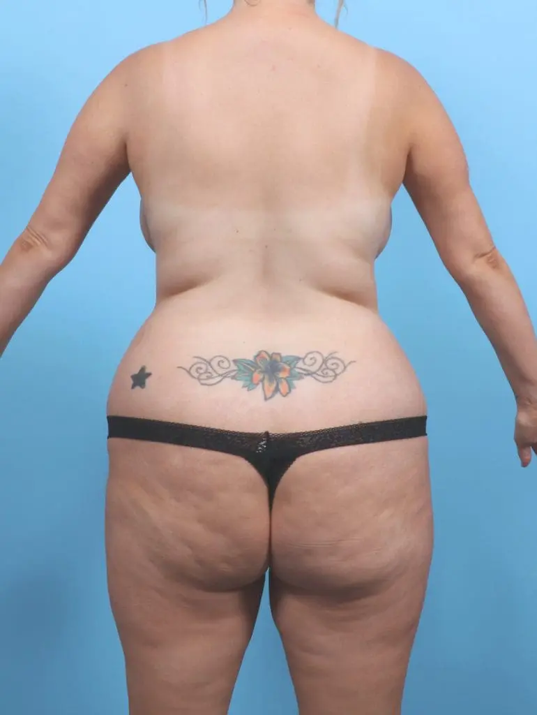 Liposuction - Case 58242 - Before