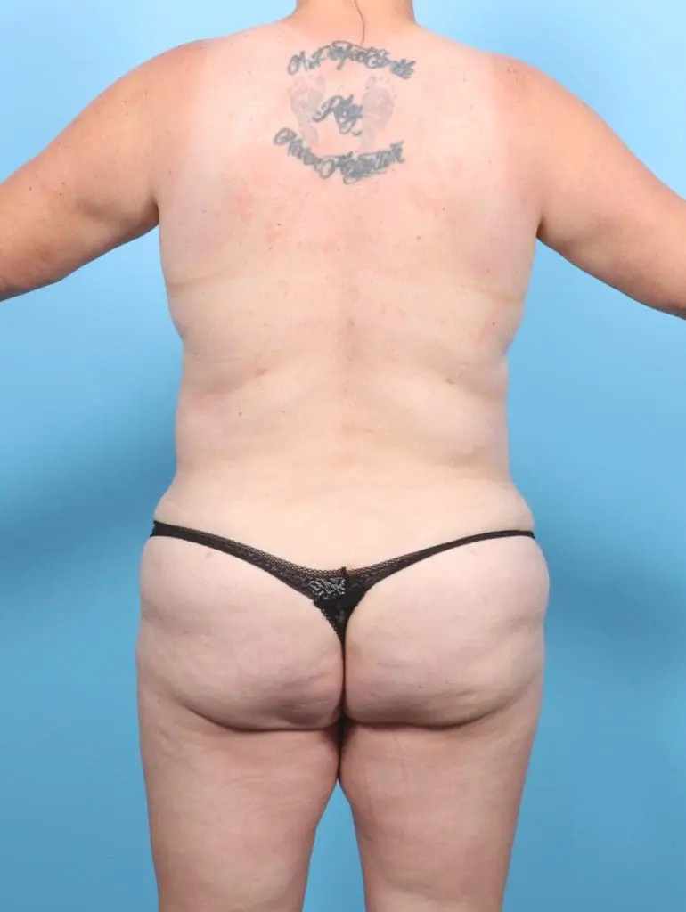 Liposuction - Case 58246 - After