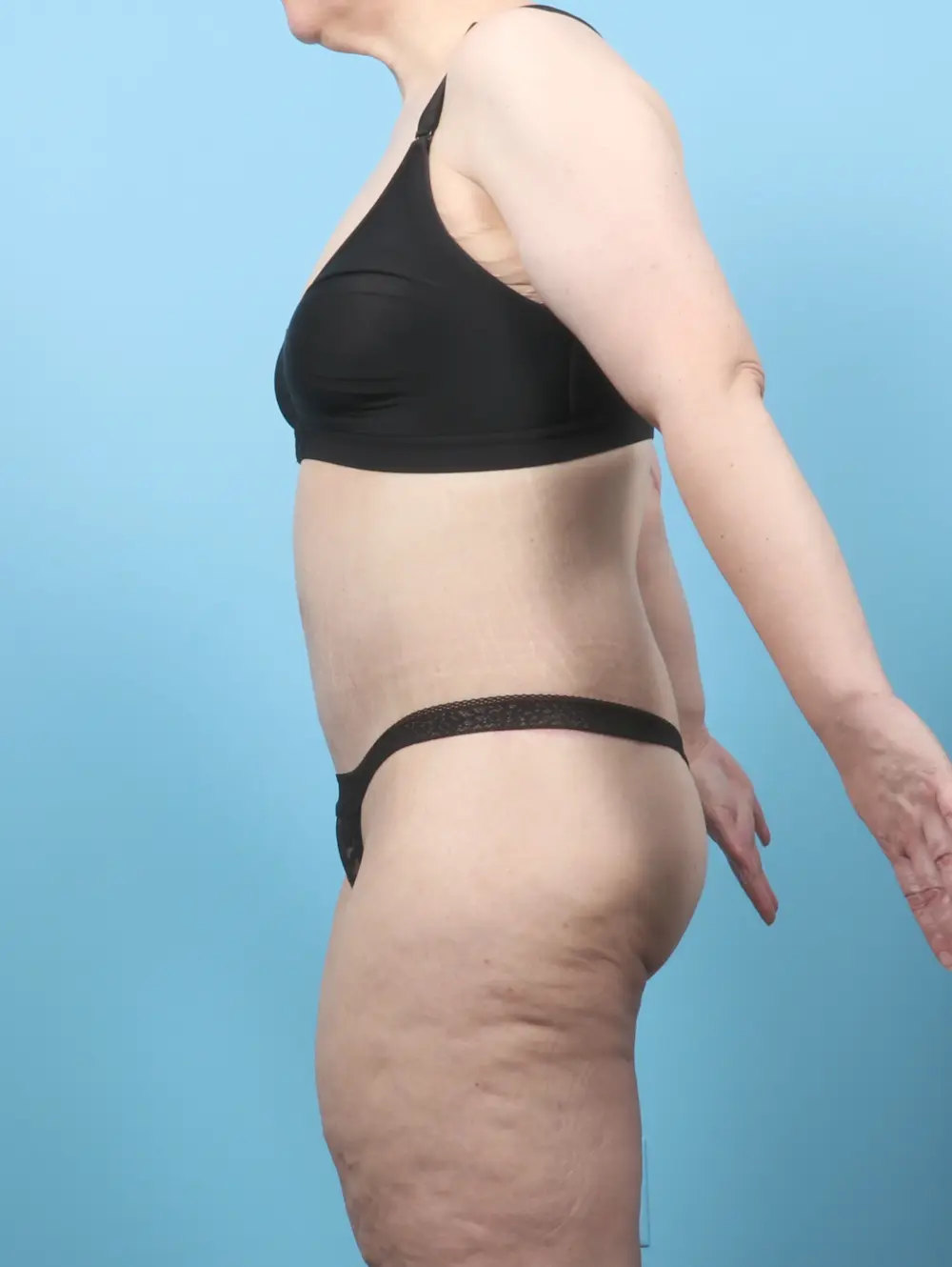 After Weight Loss Patient Photo - Case 58255 - after view-2