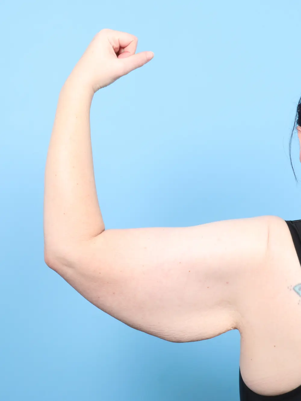 After Weight Loss Patient Photo - Case 58269 - before view-1