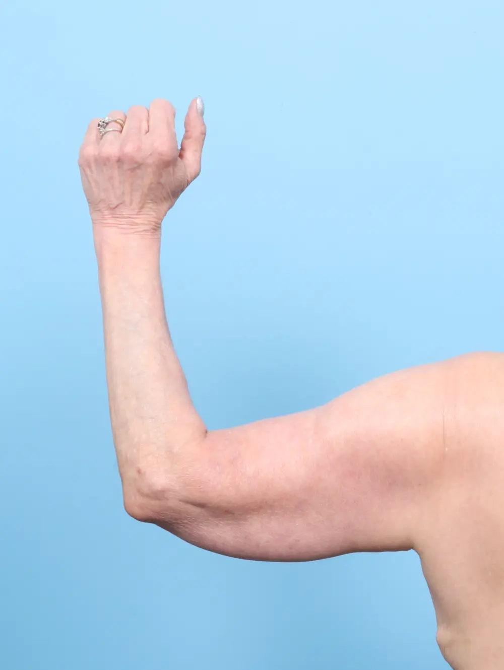 Arm Lift Patient Photo - Case 58272 - after view-1