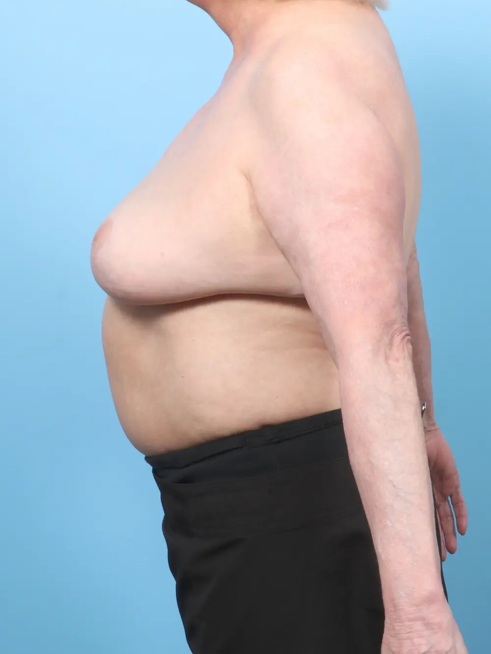 Breast Implant Removal Patient Photo - Case 58284 - after view-2