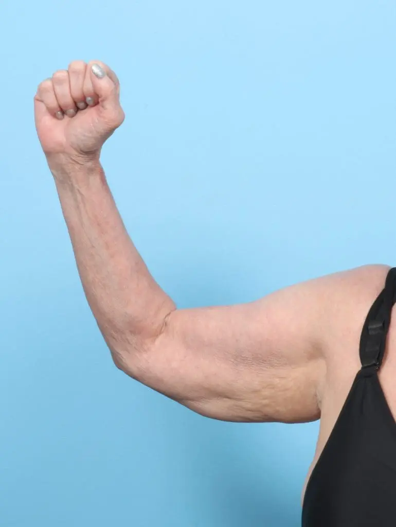 Arm Lift - Case 58272 - Before