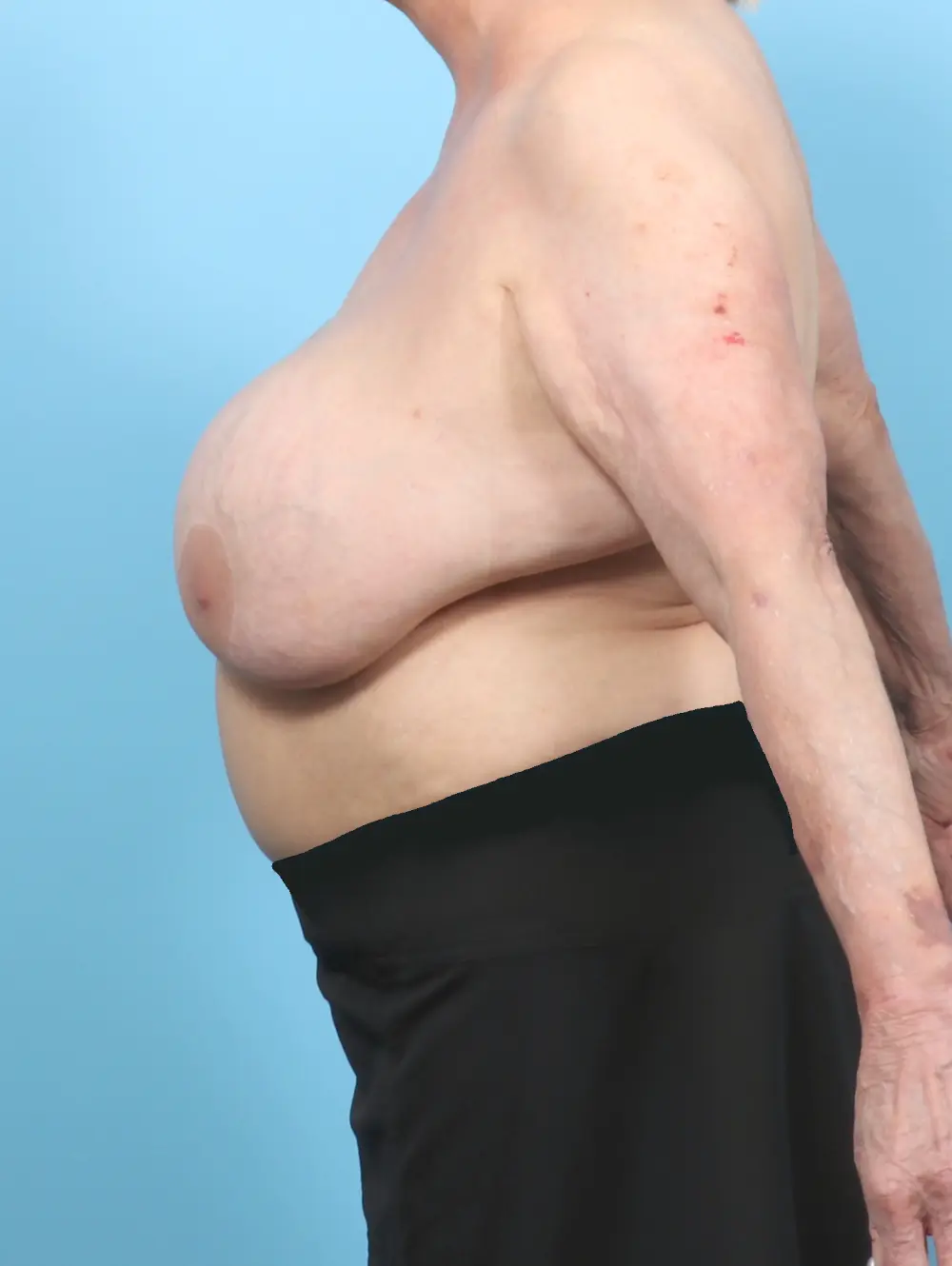 Breast Implant Removal Patient Photo - Case 58284 - before view-2