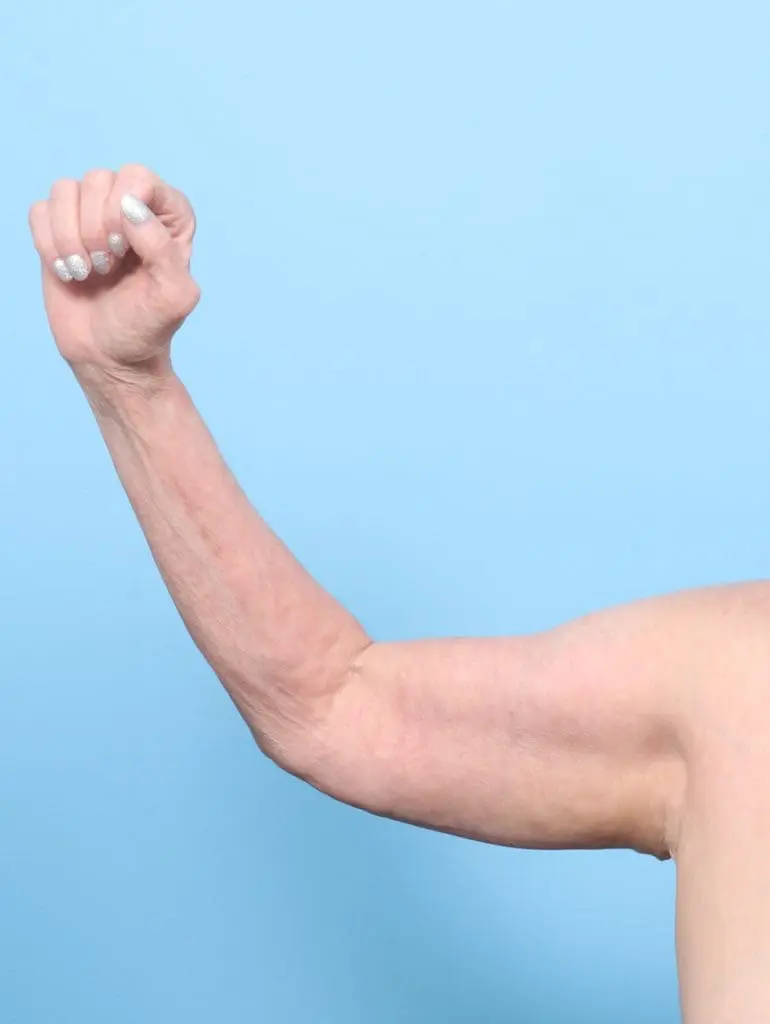 Arm Lift - Case 58272 - After