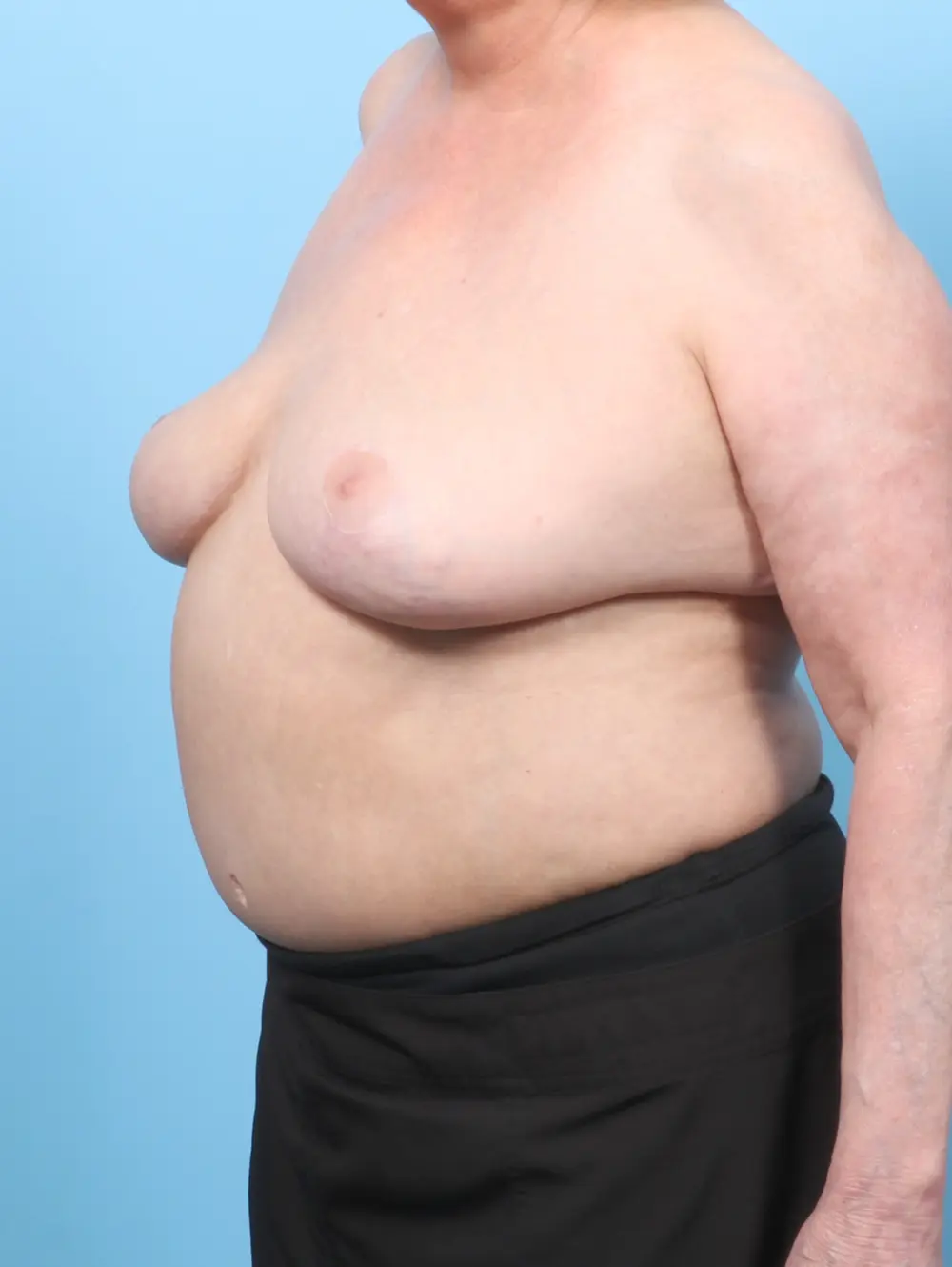 Breast Implant Removal Patient Photo - Case 58284 - after view-1