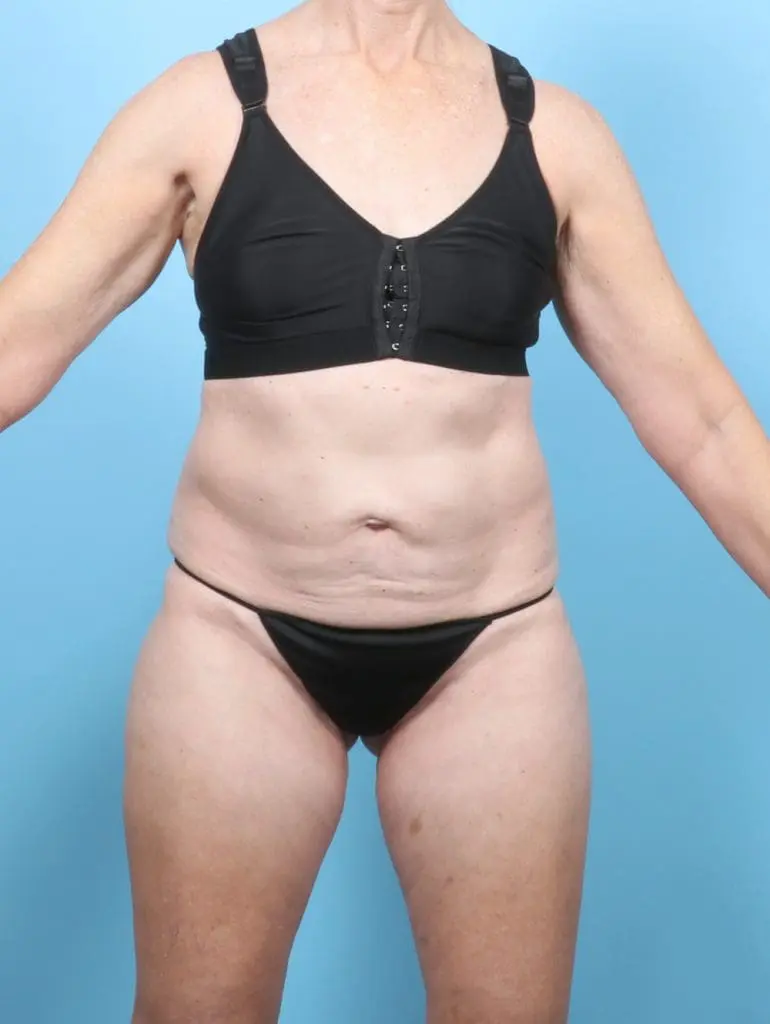 Tummy Tuck - Case 58286 - Before