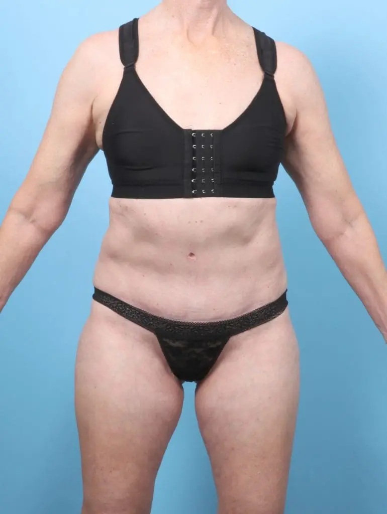 Tummy Tuck - Case 58286 - After