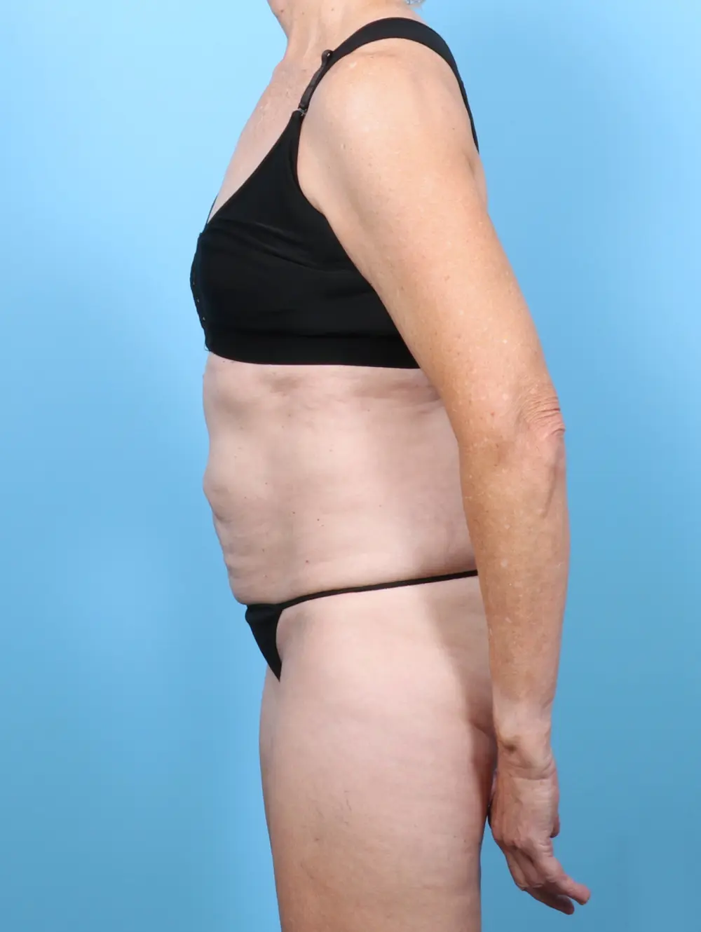 Tummy Tuck Patient Photo - Case 58286 - before view-2