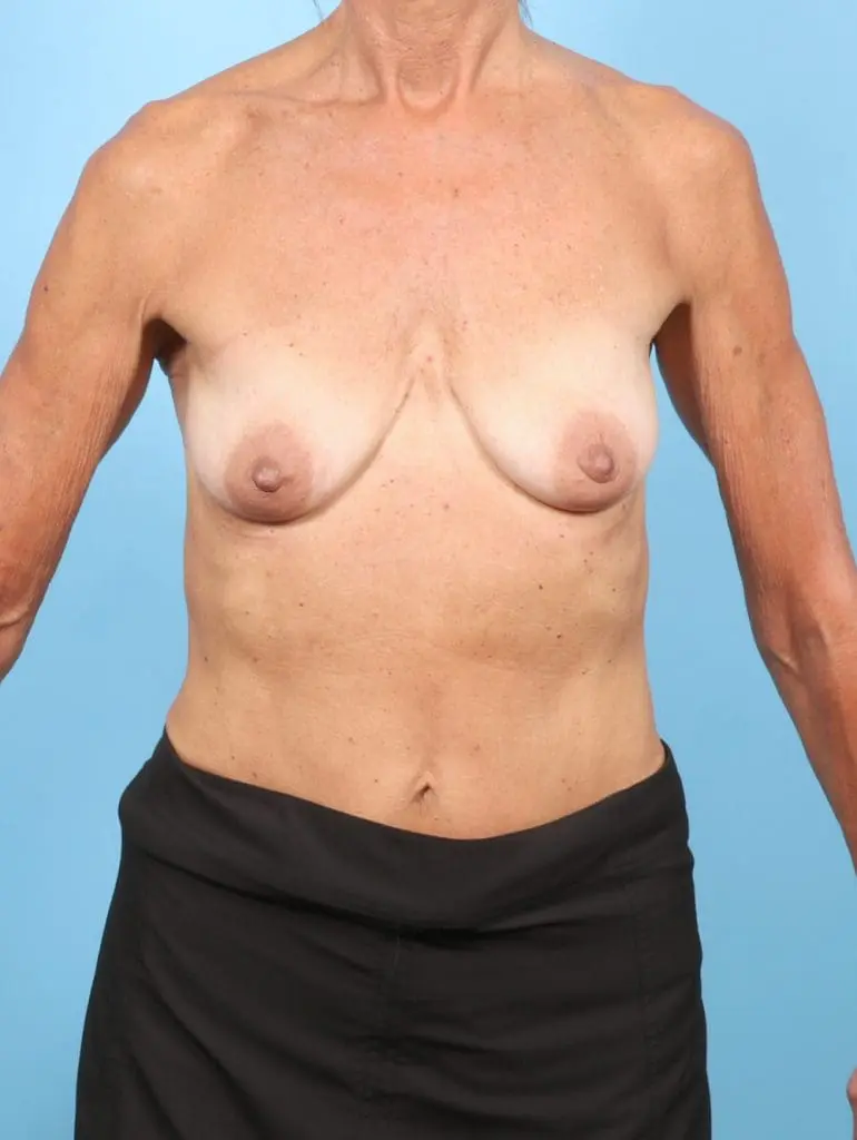 Breast Lift/Reduction with Implants - Case 58304 - Before