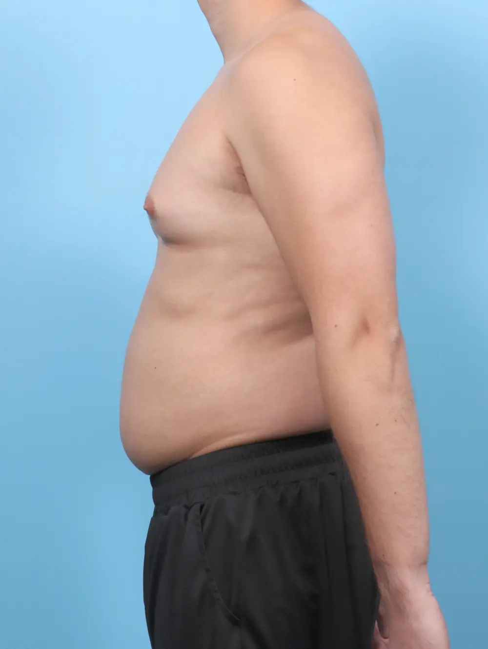 Gynecomastia Patient Photo - Case 58321 - before view-2