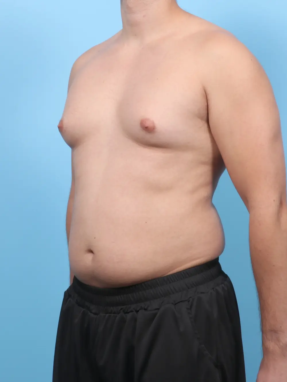 Gynecomastia Patient Photo - Case 58321 - before view-1
