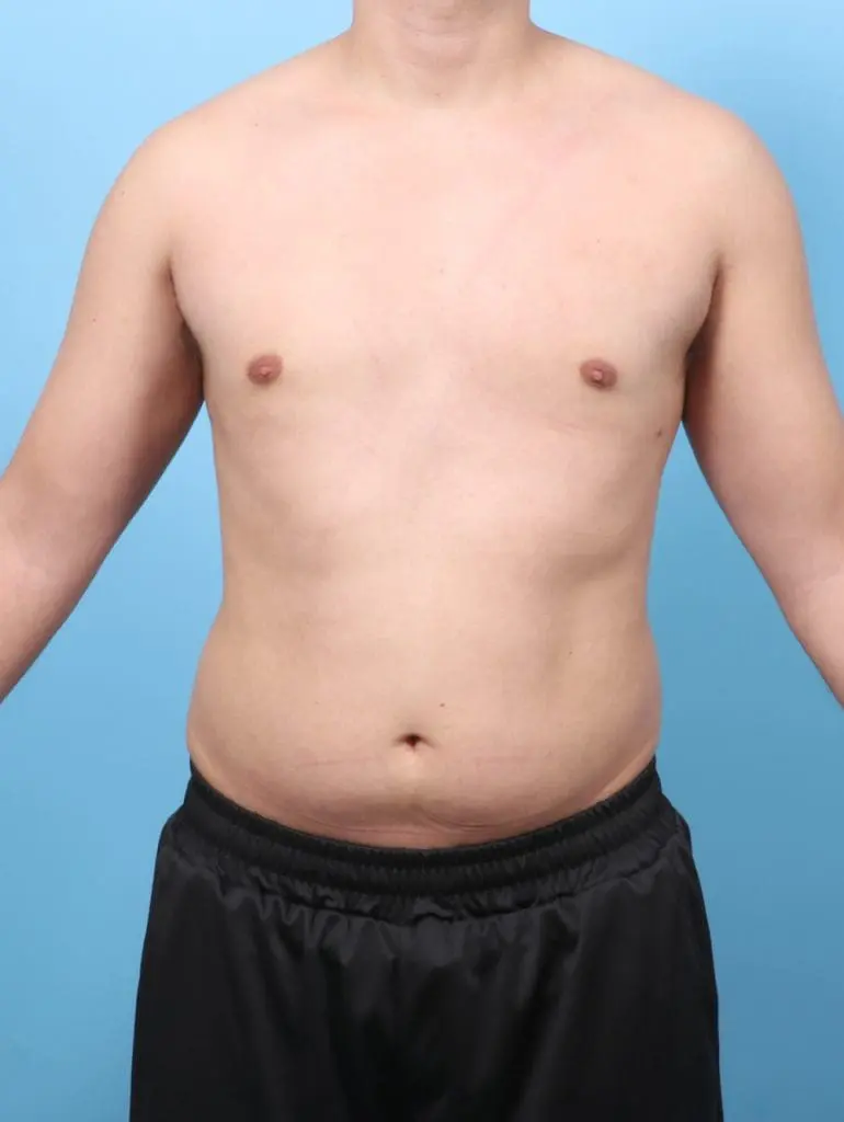 Gynecomastia - Case 58321 - After