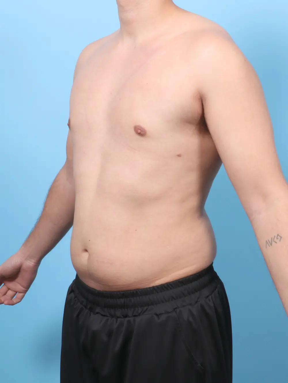 Gynecomastia Patient Photo - Case 58321 - after view-1