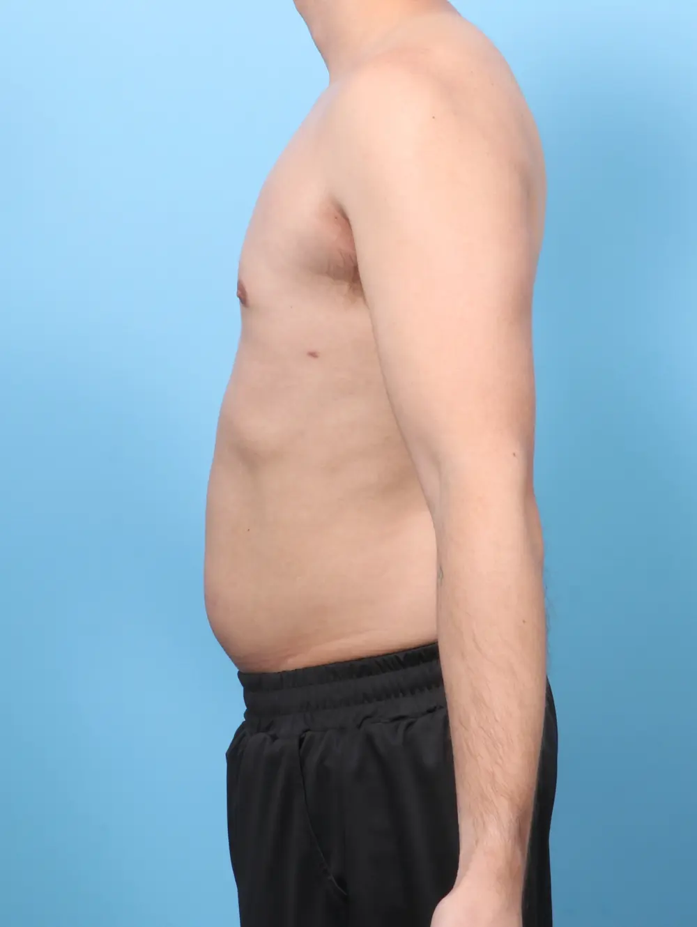 Gynecomastia Patient Photo - Case 58321 - after view-2