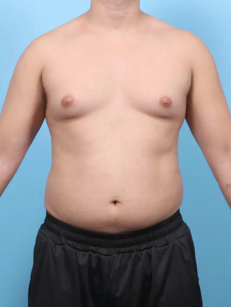 Gynecomastia - Case 58321 - Before