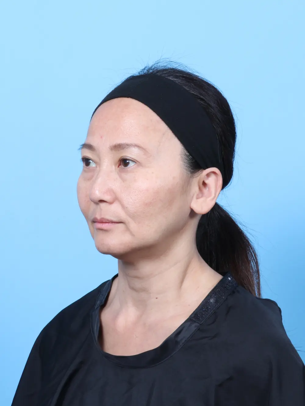 Eyelid Surgery Patient Photo - Case 58329 - after view-1