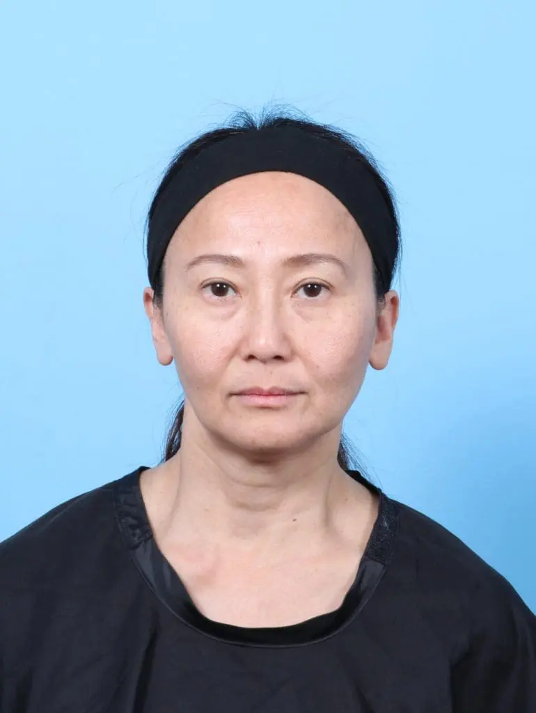 Eyelid Surgery - Case 58329 - After