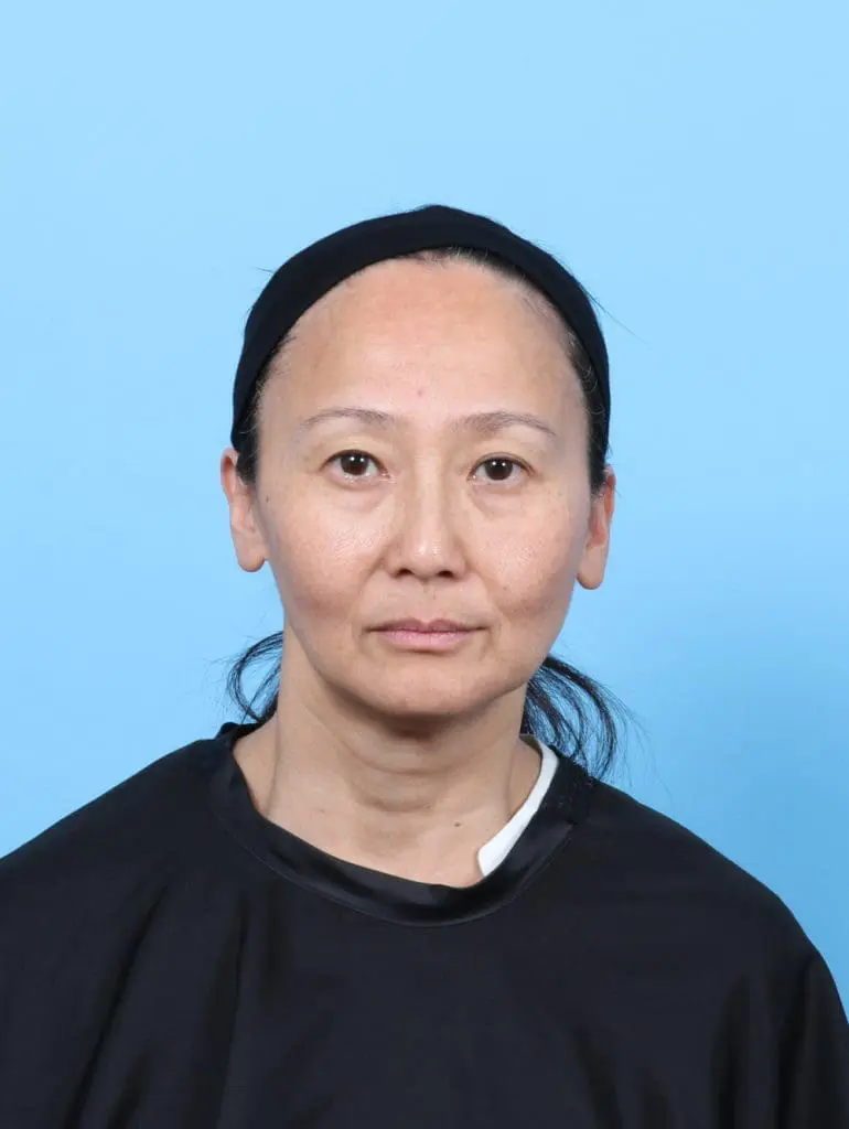 Eyelid Surgery - Case 58329 - Before