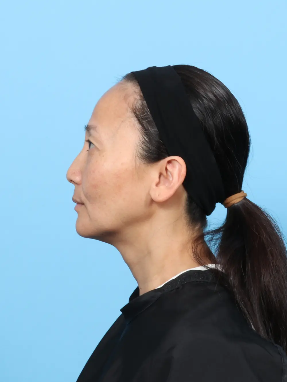 Eyelid Surgery Patient Photo - Case 58329 - before view-2