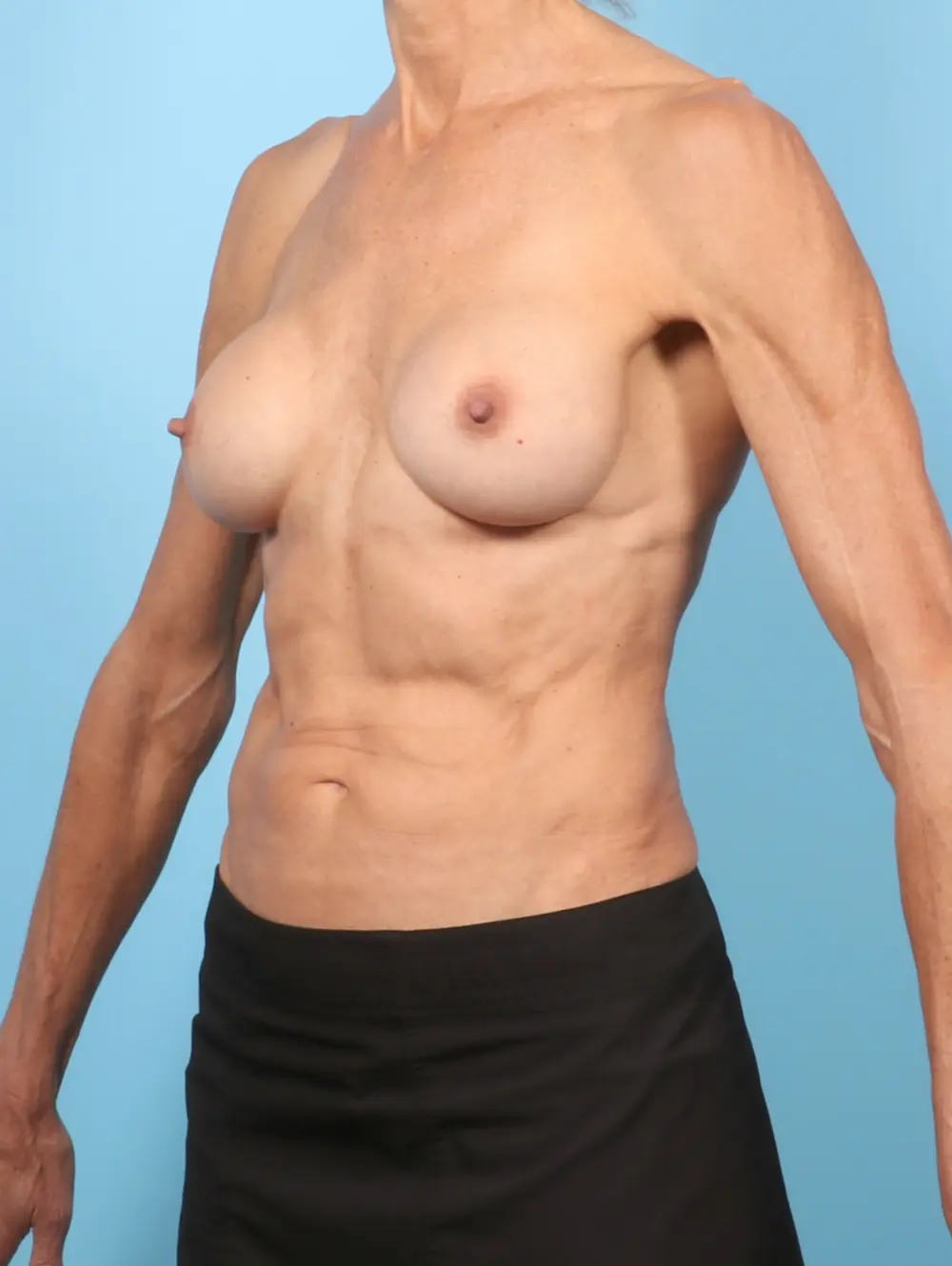 Breast Implant Revision Patient Photo - Case 58345 - before view-1