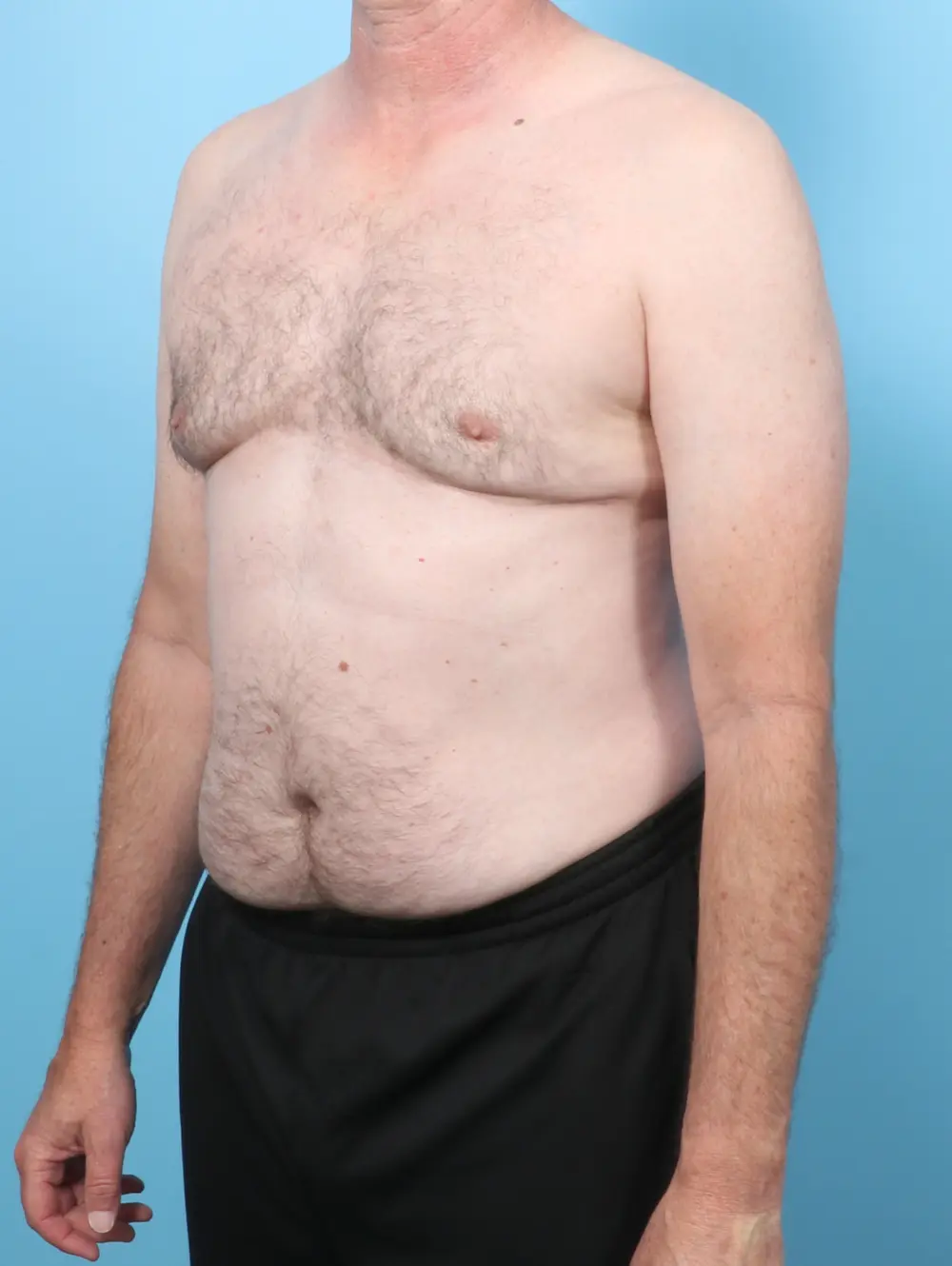 Gynecomastia Patient Photo - Case 58361 - after view-1