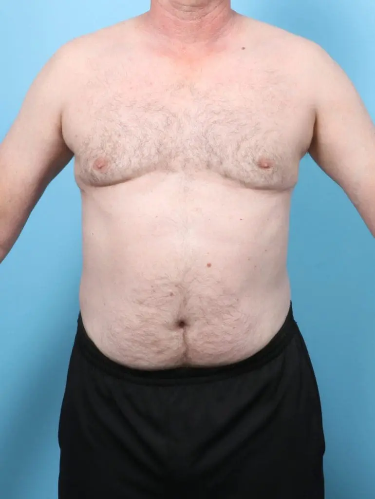 Gynecomastia - Case 58361 - After