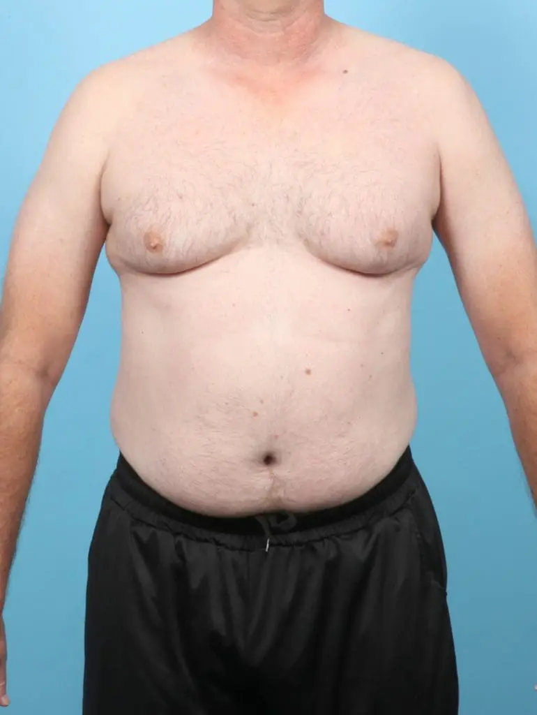 Gynecomastia - Case 58361 - Before