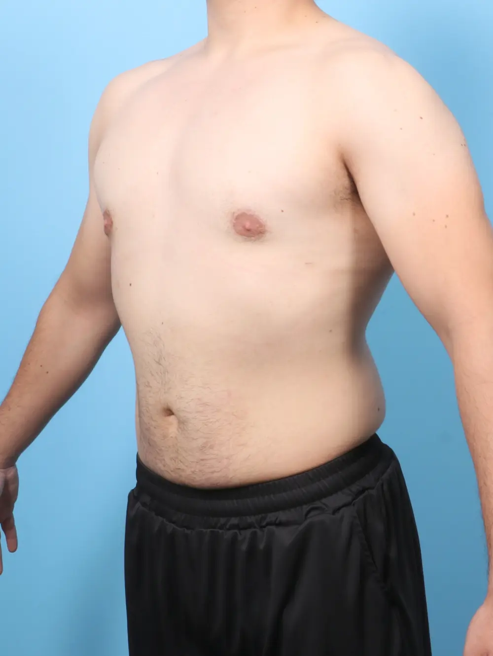 Gynecomastia Patient Photo - Case 58369 - after view-1