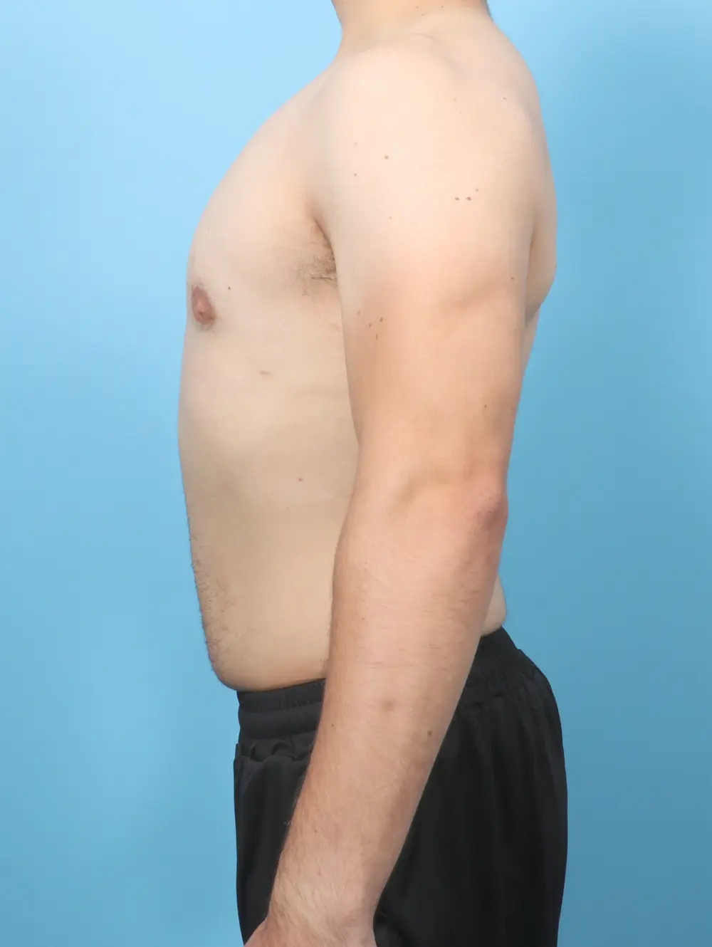 Gynecomastia Patient Photo - Case 58369 - after view-2
