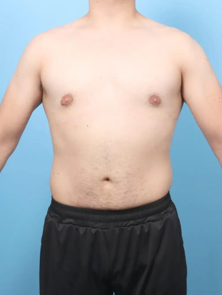 Gynecomastia - Case 58369 - After