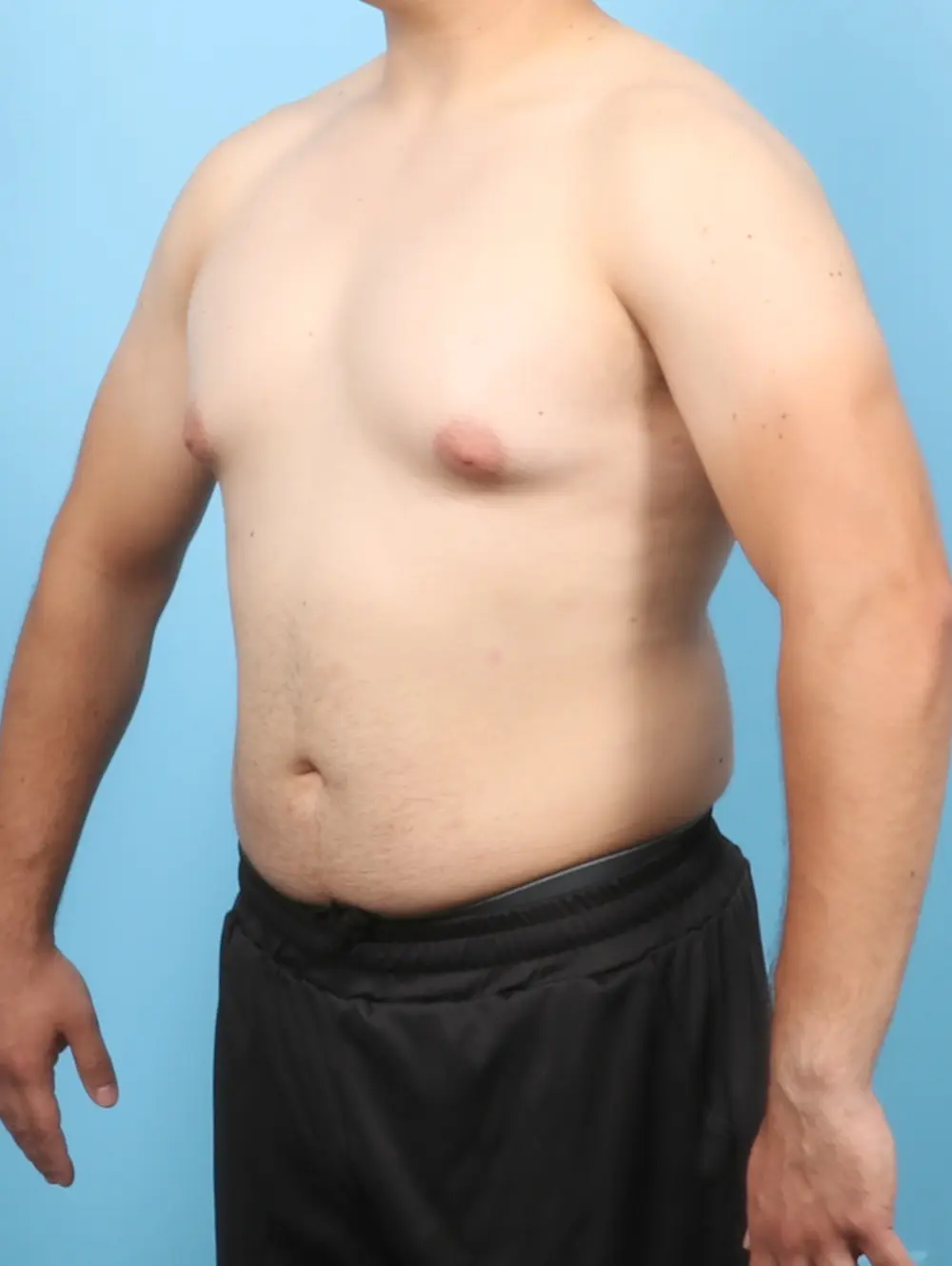 Gynecomastia Patient Photo - Case 58369 - before view-1