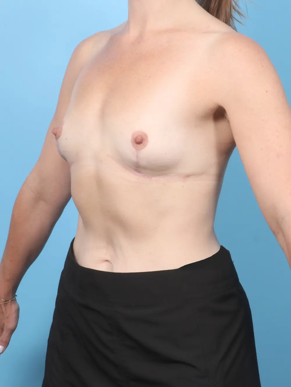 Breast Implant Removal Patient Photo - Case 58385 - after view-1