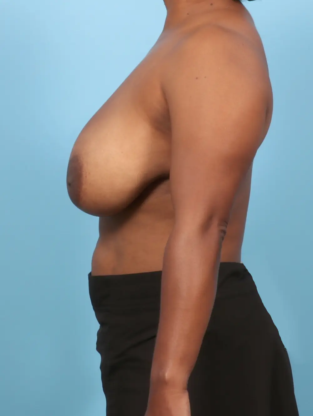 Breast Lift/Reduction w/o Implants Patient Photo - Case 58502 - before view-2